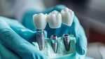 Dental Implants Guide: Essential Information for Understanding Tooth Replacement Options
