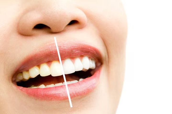 Teeth Whitening Guide: Essential Methods, Benefits, and Oral Care Information